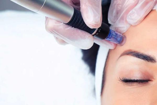 Microneedling with Glycolic Peel by iS CLINICAL® | Face