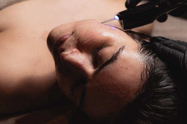 Dermapen Face and Neck