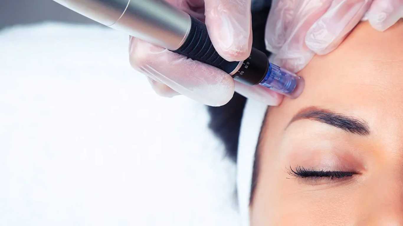 Microneedling | Face