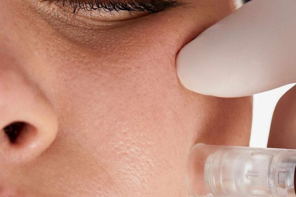 pro skin needling with skin peel